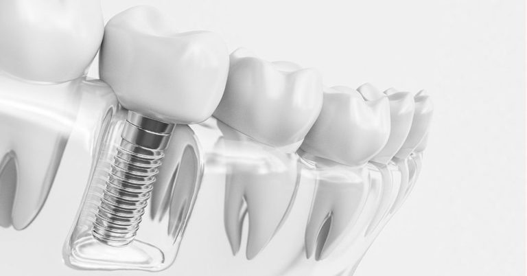 dental-implants-01-960w