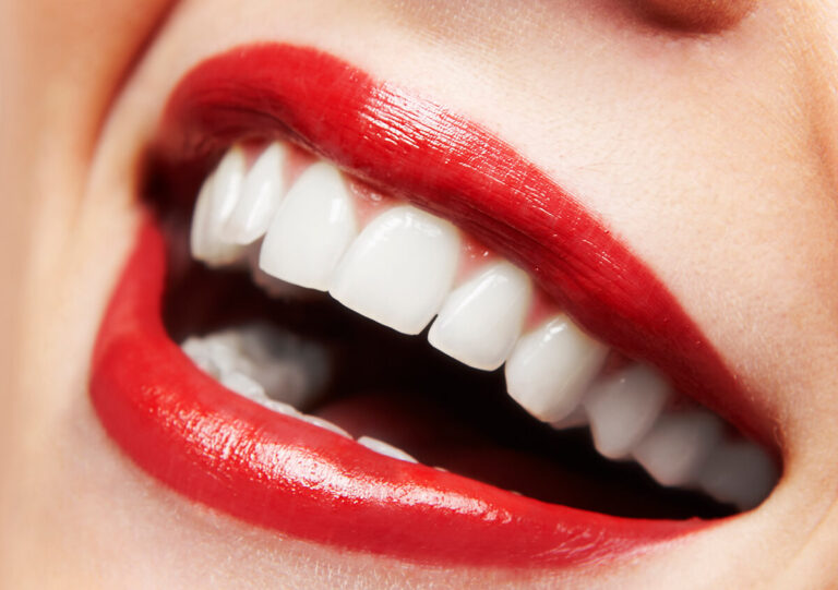 porcelain-teeth-crowns-lakewood-ranch-fl