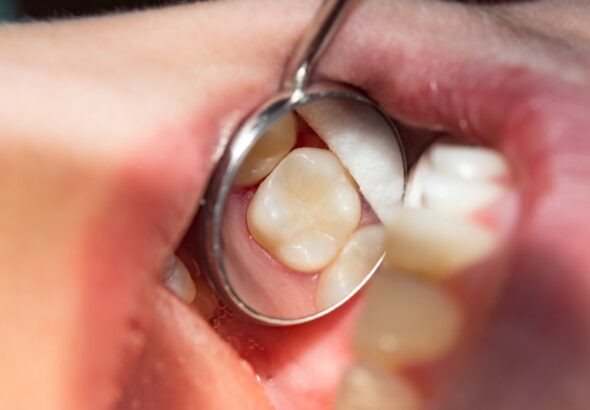 Tooth_colored_filling__1597712707_65059