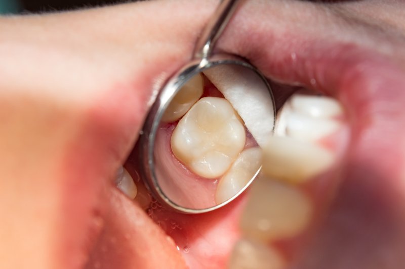 Tooth_colored_filling__1597712707_65059