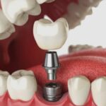 Tooth Replacement