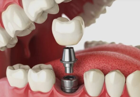 Tooth Replacement
