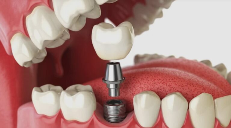 Tooth Replacement