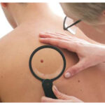 Skin Cancer Removal