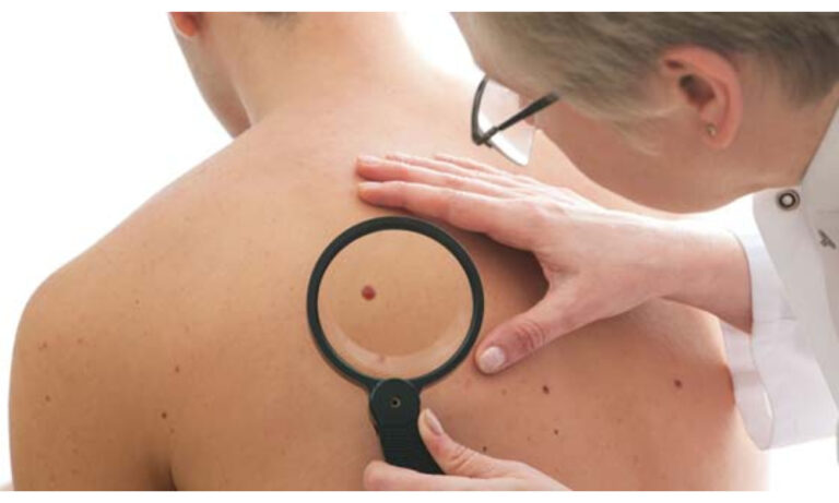 Skin Cancer Removal